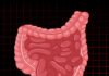 Inflammatory Bowel Disease (IBD)