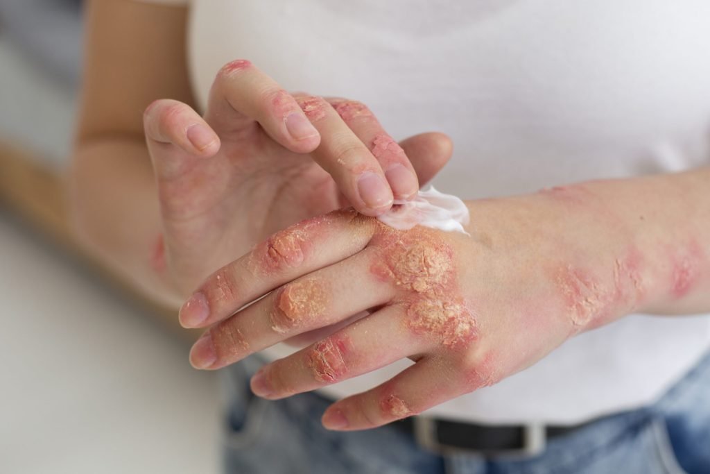 Hands patient suffering from psoriasis