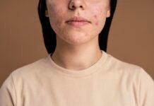 Oral and Genital Herpes, Symptoms, Causes and Treatments