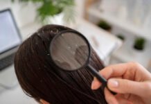 10 Natural Remedies for Dandruff