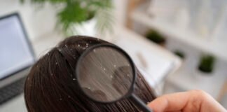 10 Natural Remedies for Dandruff