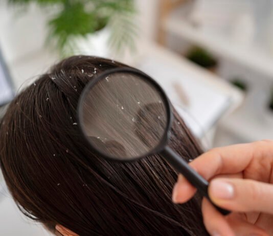 10 Natural Remedies for Dandruff