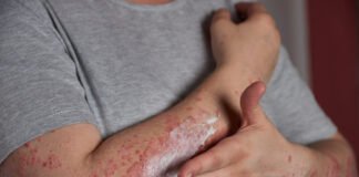 Skin Cancer vs. Psoriasis: How to Tell the Difference