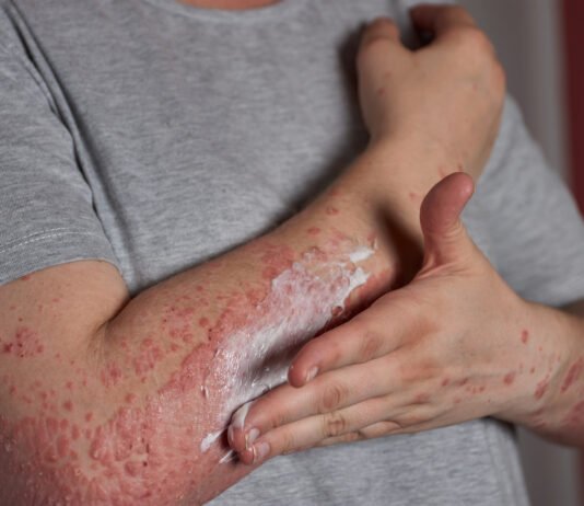 Skin Cancer vs. Psoriasis: How to Tell the Difference