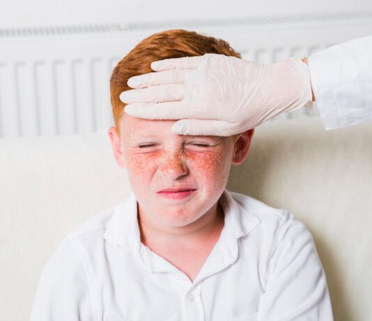 Measles: Causes, Symptoms, Prevention, and Treatment