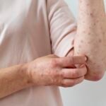 What are Lupus and What Type of Sleep Disorders Do People with Lupus Experience?