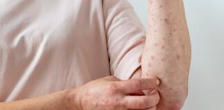 What are Lupus and What Type of Sleep Disorders Do People with Lupus Experience?