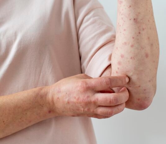 What are Lupus and What Type of Sleep Disorders Do People with Lupus Experience?