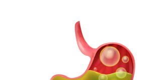 Acid Reflux and GERD