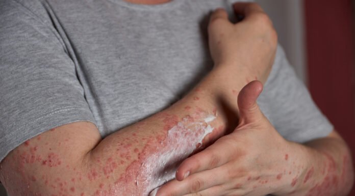 What is Fever Blister? Give its Remedies, Causes, and Management