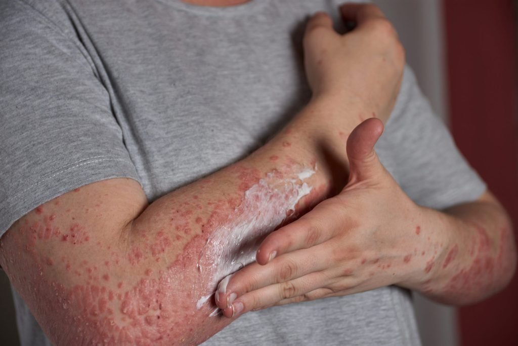 Applying moisturizer skin with psoriasis