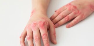 What Is Contact Dermatitis? Causes, Symptoms, and Treatments