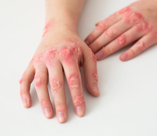 What Is Contact Dermatitis? Causes, Symptoms, and Treatments