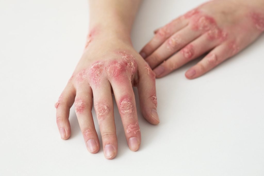 Hands patient suffering from psoriasis