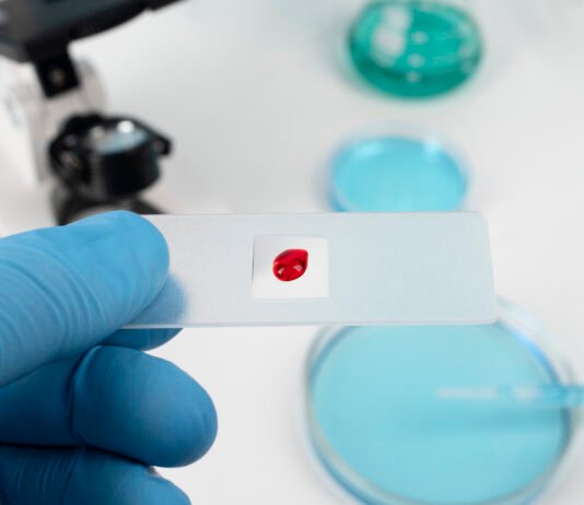 What to Know About T-Cell Leukemia