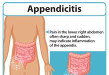 Appendicitis: Signs, Causes and Treatment