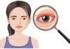 Thyroid Eye Disease (Graves’ Eye Disease)