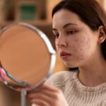 What is Acne Vulgaris (Hormonal Acne)? The Best Diet and Supplements for Prevention and Treatment