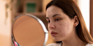 What is Acne Vulgaris (Hormonal Acne)? The Best Diet and Supplements for Prevention and Treatment