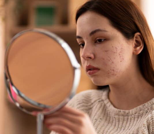 What is Acne Vulgaris (Hormonal Acne)? The Best Diet and Supplements for Prevention and Treatment