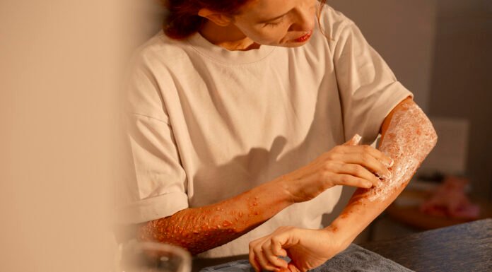 Type 2 Diabetes and Skin Health