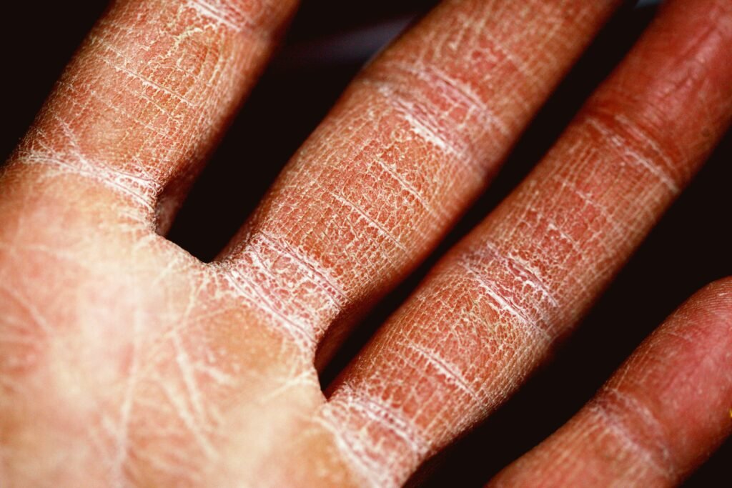 Shingles