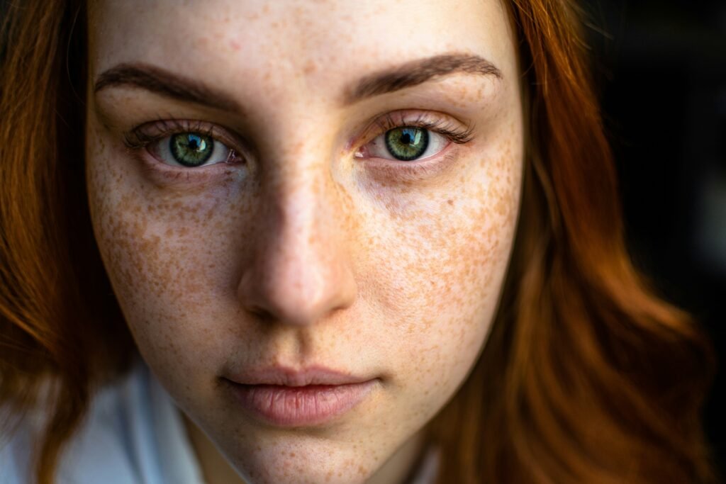 Severe Acne