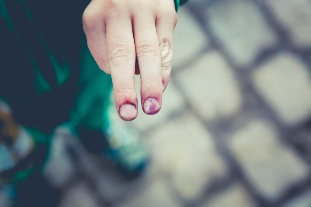 Nail Fungus