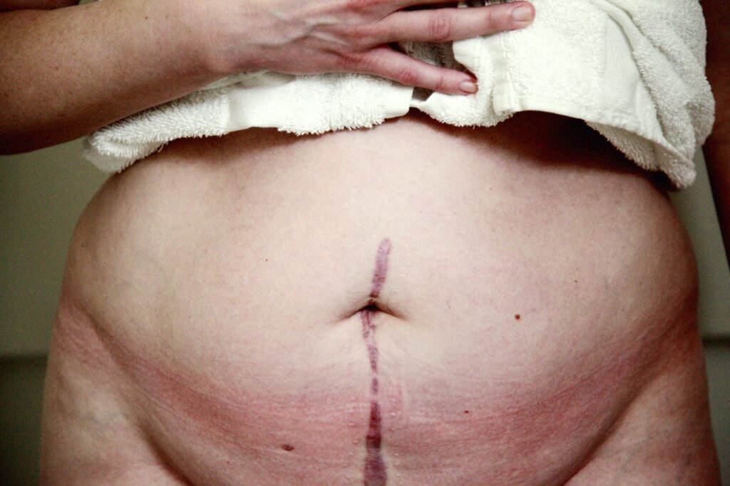 Hernia